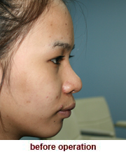 plastic_surgery_augmentation_rhinoplasty